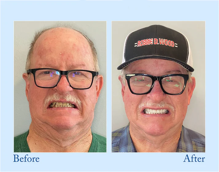 🔥Ends Tonight: Get 40% OFF Before It’s Gone!🎁 Fluoride-Free Hydroxyapatite Toothpaste for Whitening & Sensitive Enamel Care