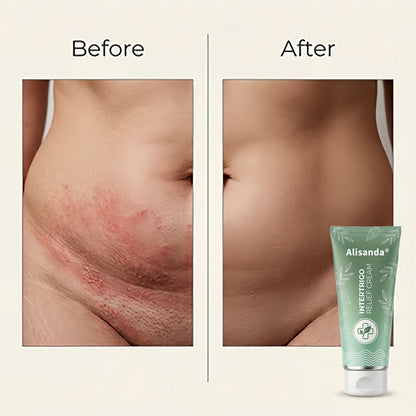 ✨ LAST DAY BUY 1 GET 1 FREE✨Intertrigo Relief Cream treats 99% of skin fold rashes from the first application