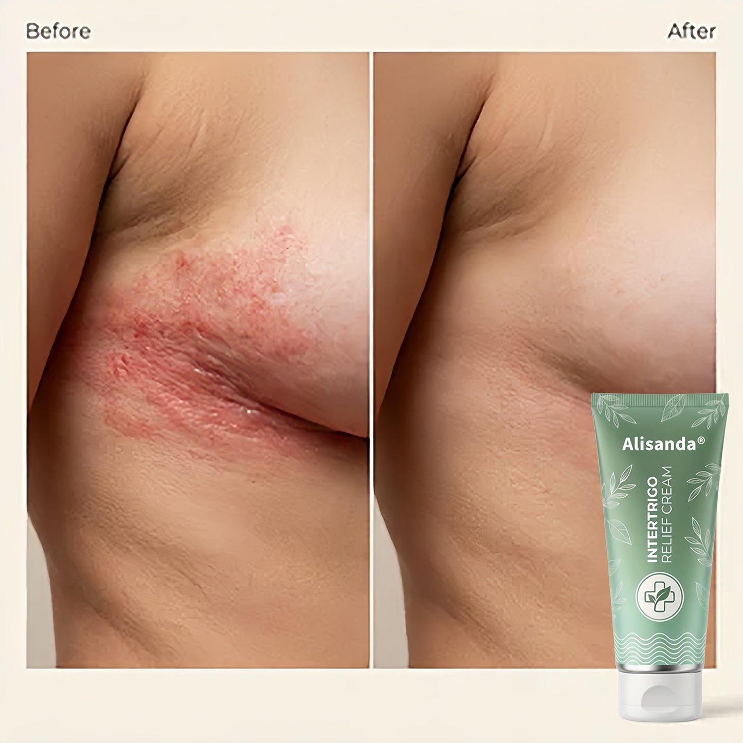✨ LAST DAY BUY 1 GET 1 FREE✨Intertrigo Relief Cream treats 99% of skin fold rashes from the first application