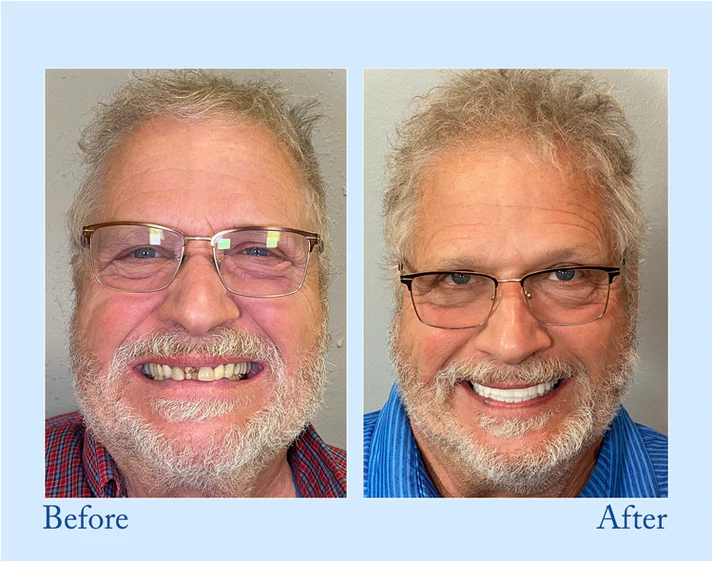 🔥Ends Tonight: Get 40% OFF Before It’s Gone!🎁 Fluoride-Free Hydroxyapatite Toothpaste for Whitening & Sensitive Enamel Care