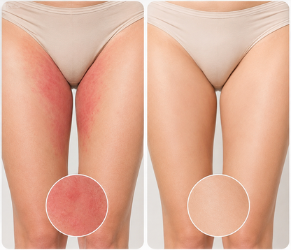 ✨ LAST DAY BUY 1 GET 1 FREE✨Intertrigo Relief Cream treats 99% of skin fold rashes from the first application