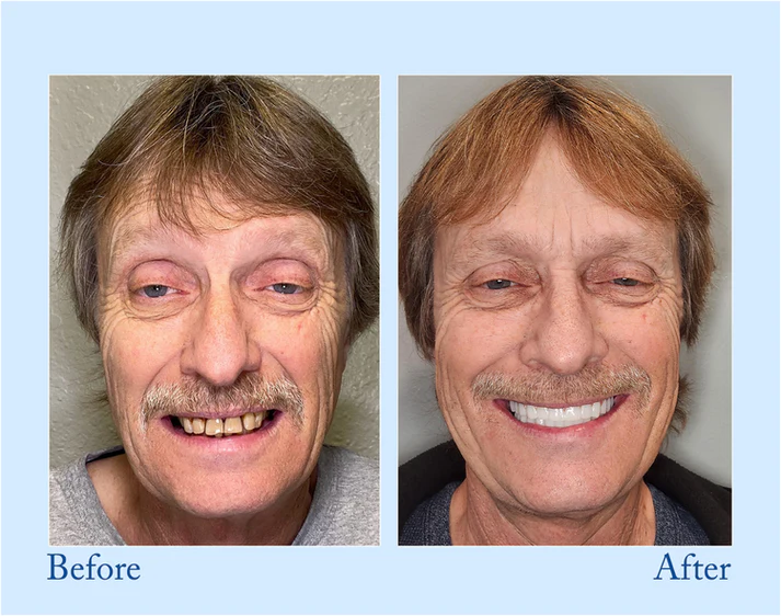 🔥Ends Tonight: Get 40% OFF Before It’s Gone!🎁 Fluoride-Free Hydroxyapatite Toothpaste for Whitening & Sensitive Enamel Care