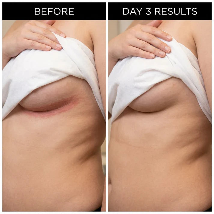 ✨ LAST DAY BUY 1 GET 1 FREE✨Intertrigo Relief Cream treats 99% of skin fold rashes from the first application