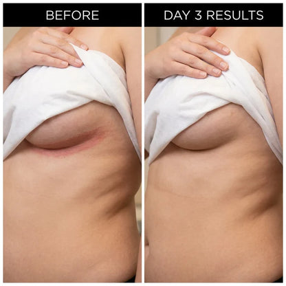 ✨ LAST DAY BUY 1 GET 1 FREE✨Intertrigo Relief Cream treats 99% of skin fold rashes from the first application