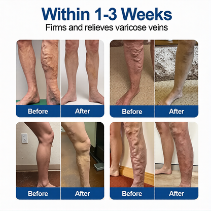 Alisanda® 𝑽𝗲𝗶𝙣 𝘾𝐨𝐧𝘁𝗼𝙪𝙧 𝙈𝙞𝐜𝐫𝒐𝒏𝒆𝗲𝗱𝗹𝙚 𝙋𝙖𝐭𝐜𝒉 𝒘𝒊𝘁𝗵 𝗔𝙙𝙫𝙖𝙣𝙘𝐞𝐝 𝐃𝒊𝒐𝒔𝗺𝙞𝐧 & 𝑯𝒆𝘀𝗽𝗲𝙧𝙞𝙙𝙞𝐧 𝐃𝒆𝒍𝒊𝒗𝗲𝗿𝙮🌿𝟕-𝐃𝐚𝐲 𝐕𝐢𝐬𝐢𝐛𝐥𝐞 𝐑𝐞𝐬𝐮𝐥𝐭𝐬 𝐟𝐨𝐫 𝐕𝐚𝐫𝐢𝐜𝐨𝐬𝐞 𝐕𝐞𝐢𝐧𝐬 — 𝗔𝗱𝘃𝗮𝗻𝗰𝗲𝗱 𝗛𝗲𝗿𝗯𝗮𝗹 𝗕𝗹𝗲𝗻𝗱 𝗧𝗮𝗿𝗴𝗲𝘁𝘀 𝗦𝗽𝗶𝗱𝗲𝗿 𝗩𝗲𝗶𝗻𝘀 & 𝗥𝗲𝗹𝗶𝗲𝘃𝗲𝘀 𝗛𝗲𝗮𝘃𝘆, 𝗧𝗶𝗿𝗲𝗱 𝗟𝗲𝗴𝘀